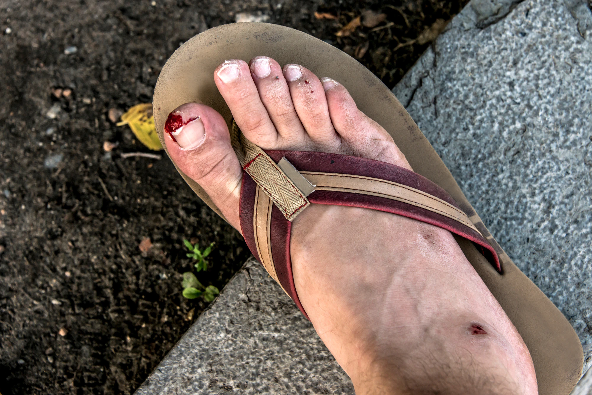 Sandals hurt sale between toes