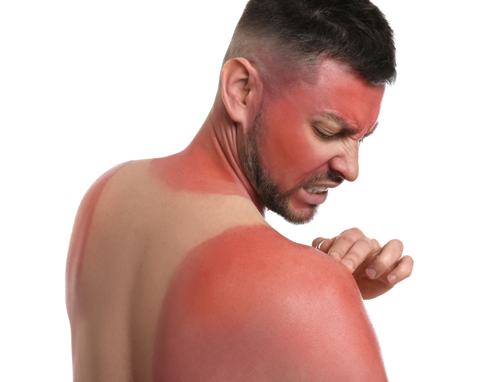 Sunburn Remedies, Sunburn Remedies Fast