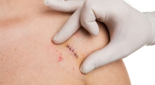 Does My Cut Need Stitches or Will It Heal on Its Own?: Walker Family Care:  Family Medicine Physicians