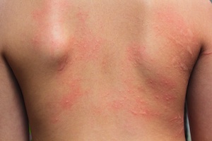 When to Worry About a Rash - Complete Care