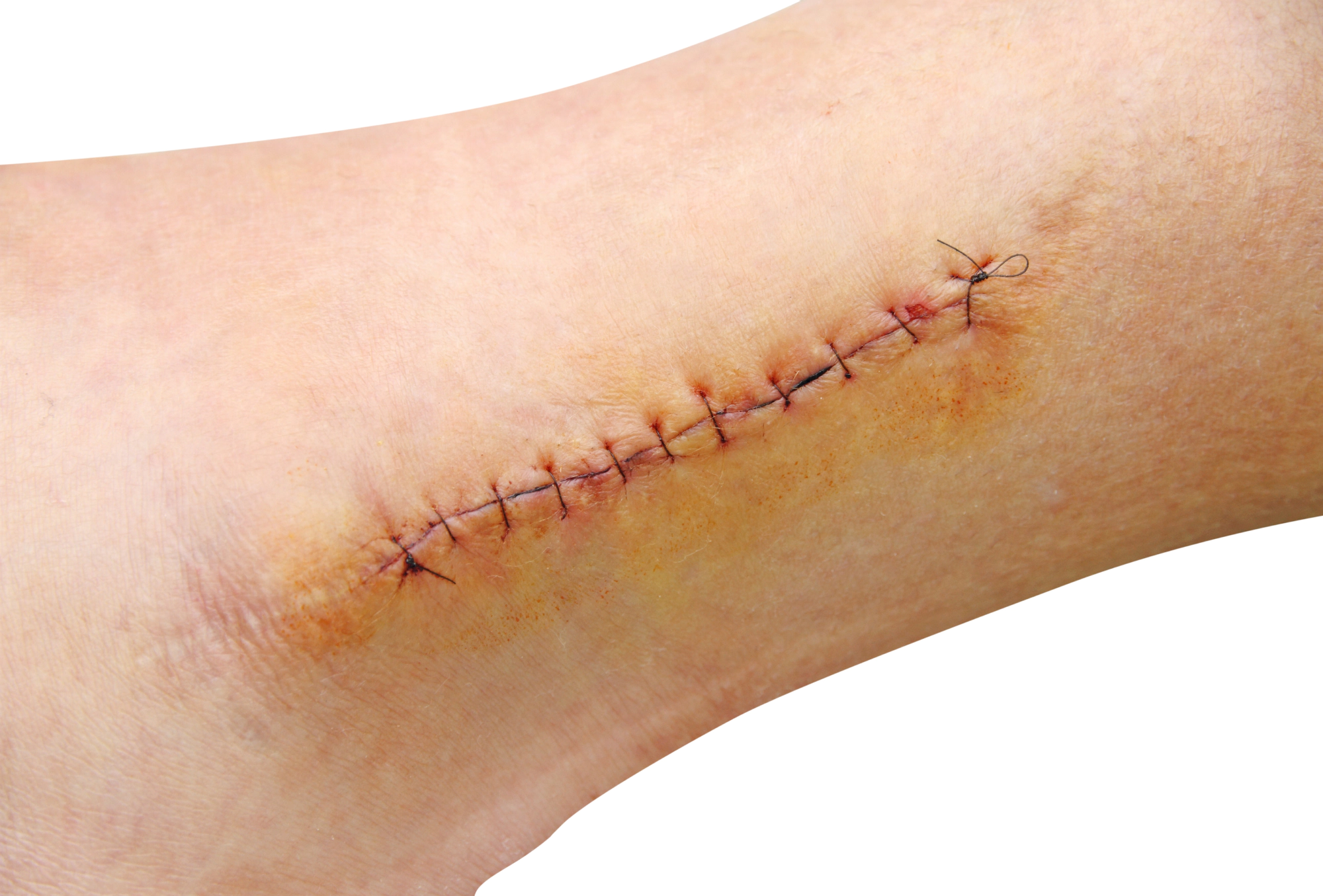 When Does a Cut Need Stitches?