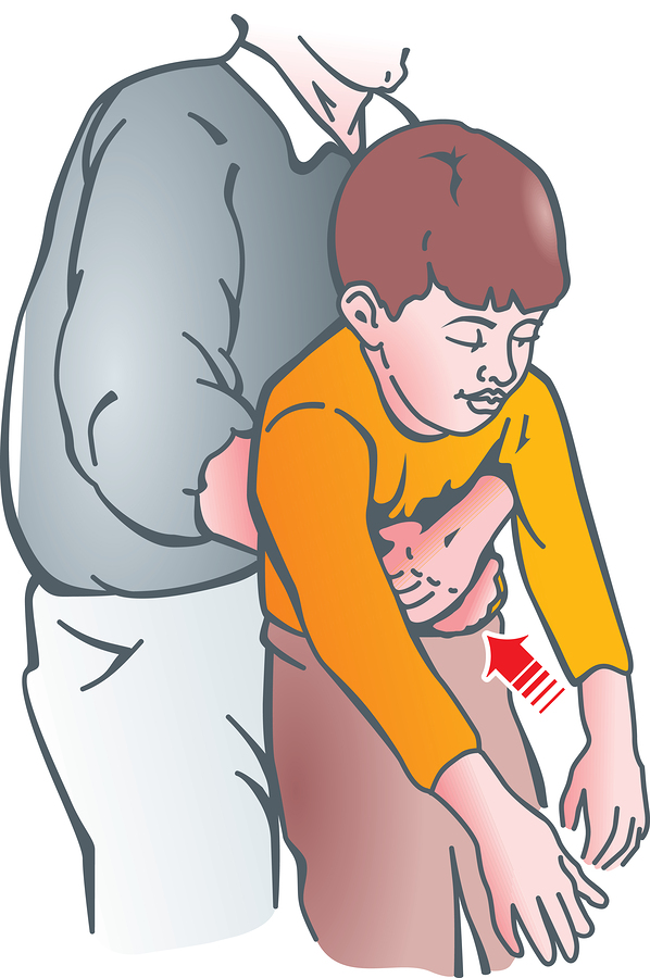 How To Do The Heimlich Maneuver On A Child Complete Care