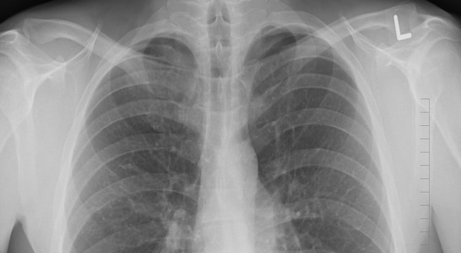 bruised ribs x ray