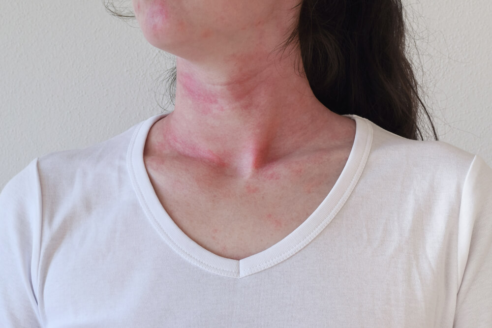 anaphylaxis rash